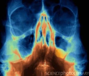 Sinus polyp.