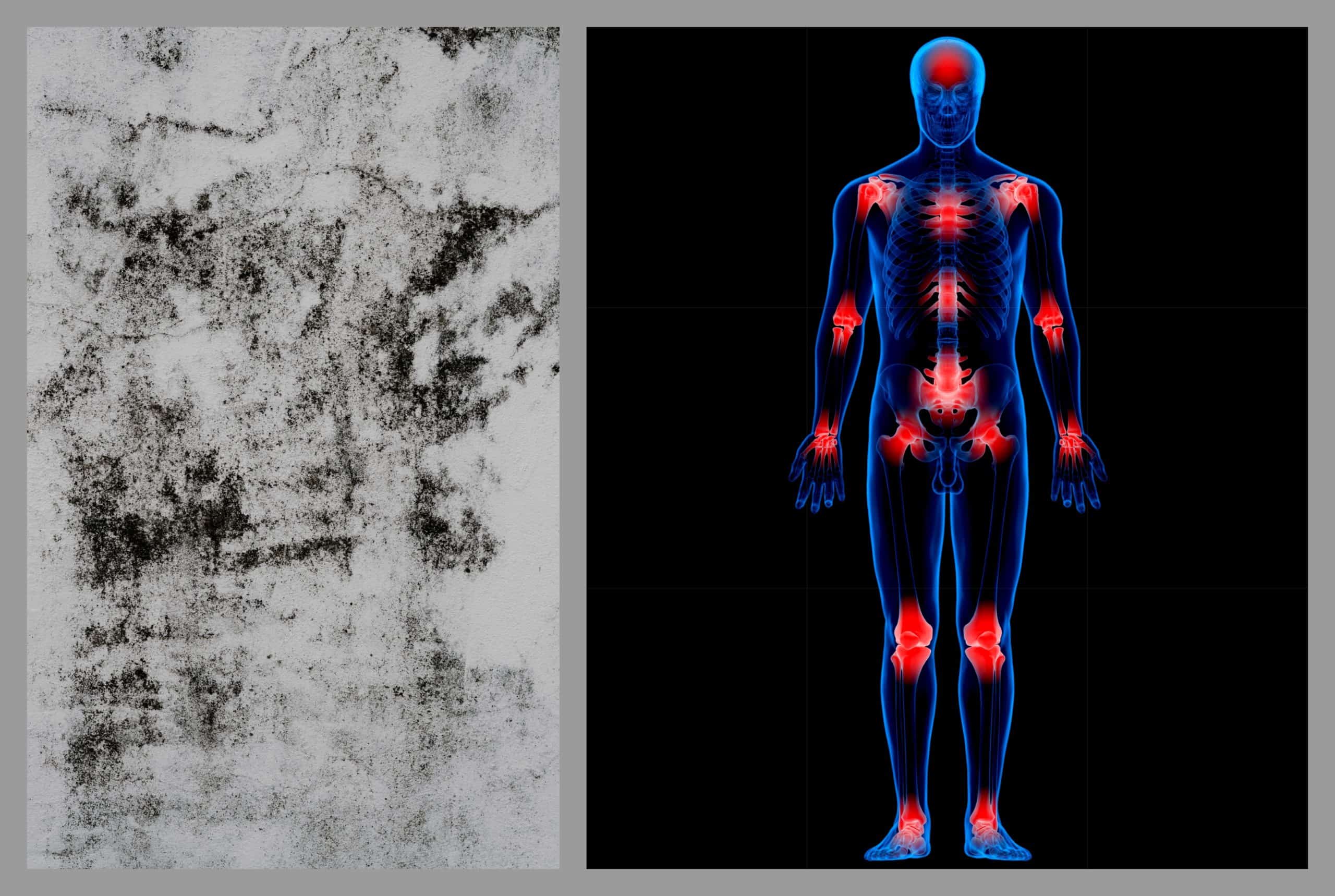 Inflammation Part 3 MoldInduced Illness